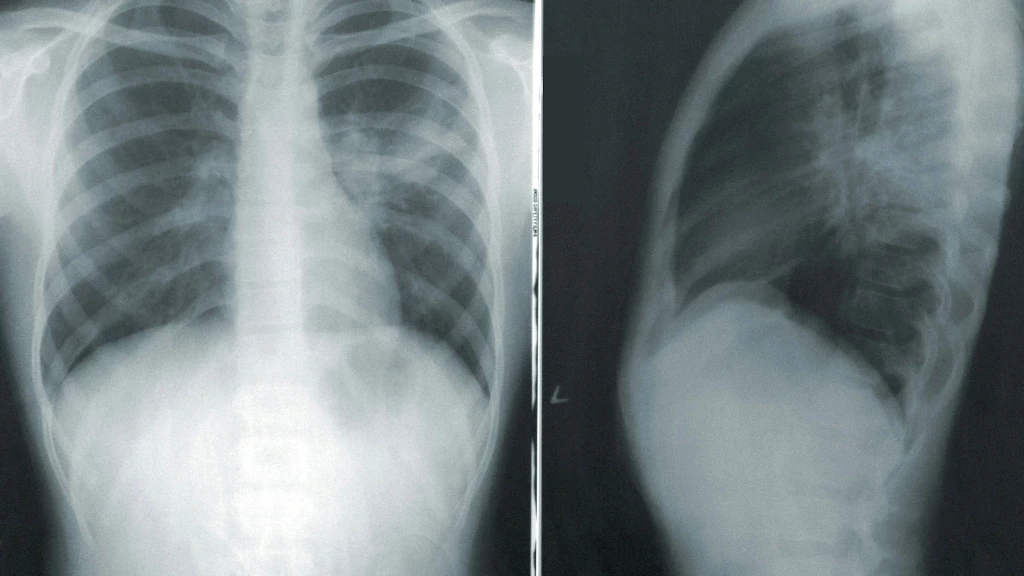 Tuberculosis Respiratoria: México Enfrenta Repunte Alarmante en 2026 con 1,289 Casos