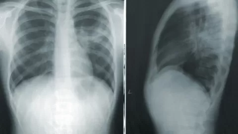 Tuberculosis Respiratoria: México Enfrenta Repunte Alarmante en 2026 con 1,289 Casos
